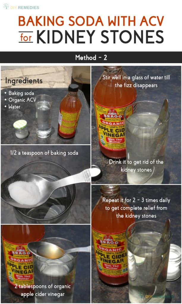 Apple Cider Vinegar and Baking soda Fresh How to Get Rid Of Kidney Stones Using Baking soda